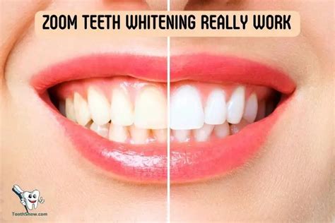 does zoom whitening really work.